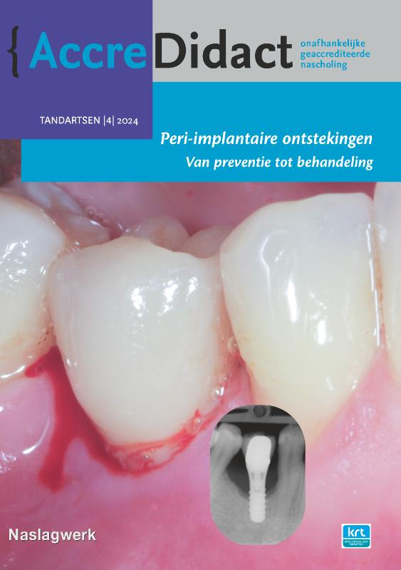 Omslag van Peri-implantaire ontstekingen